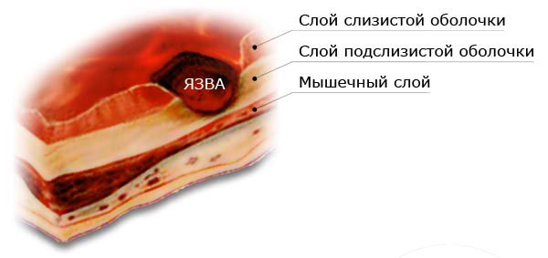 Как Выглядит Язва Фото